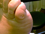 bunions